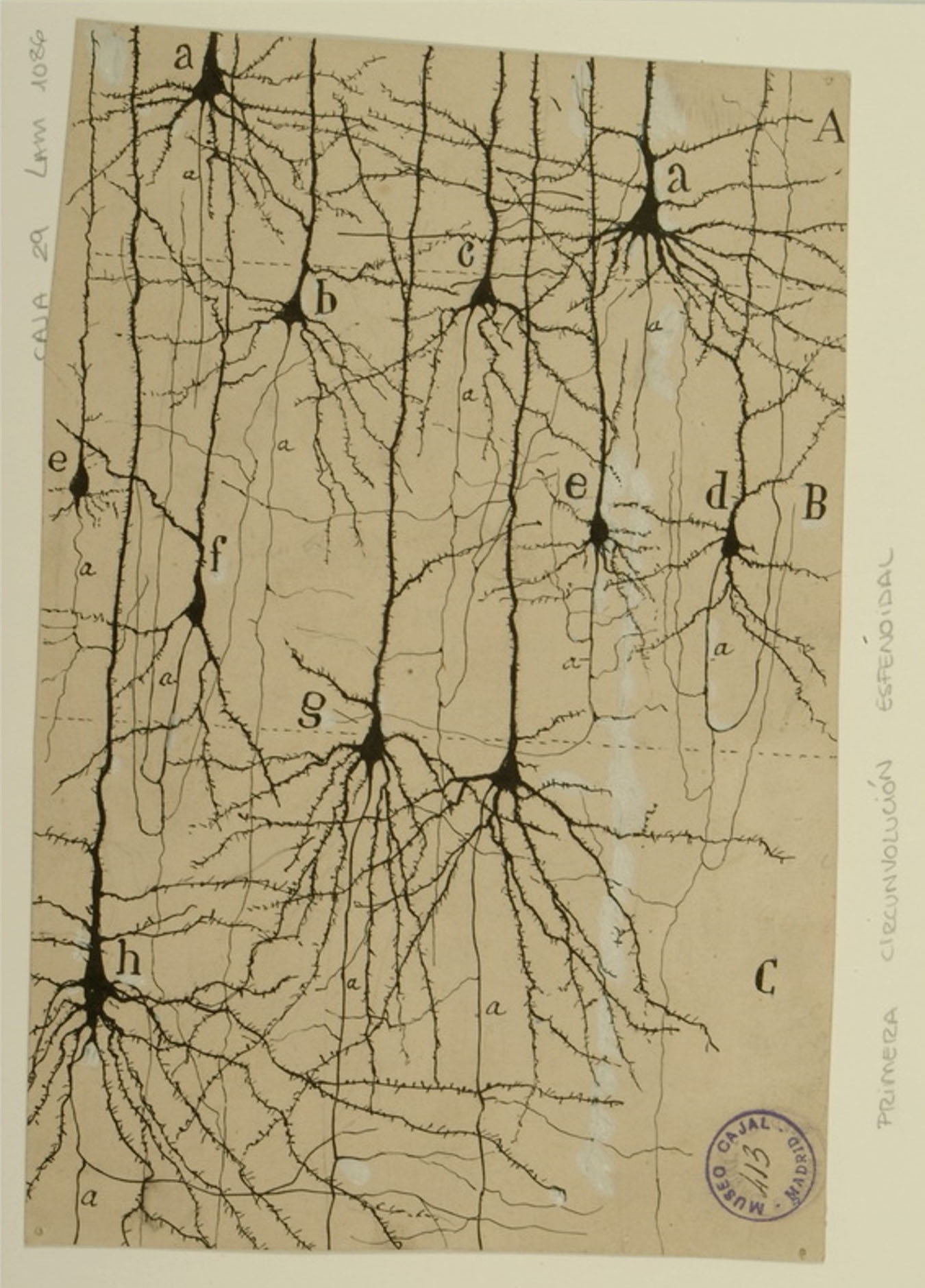Illustration of sphenoidal cortex in a 25-day old infant