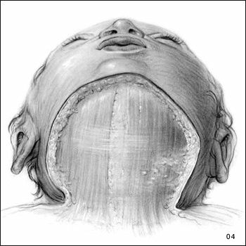 Hand-drawn illustration of Sequential Dissections of the Head from the Side