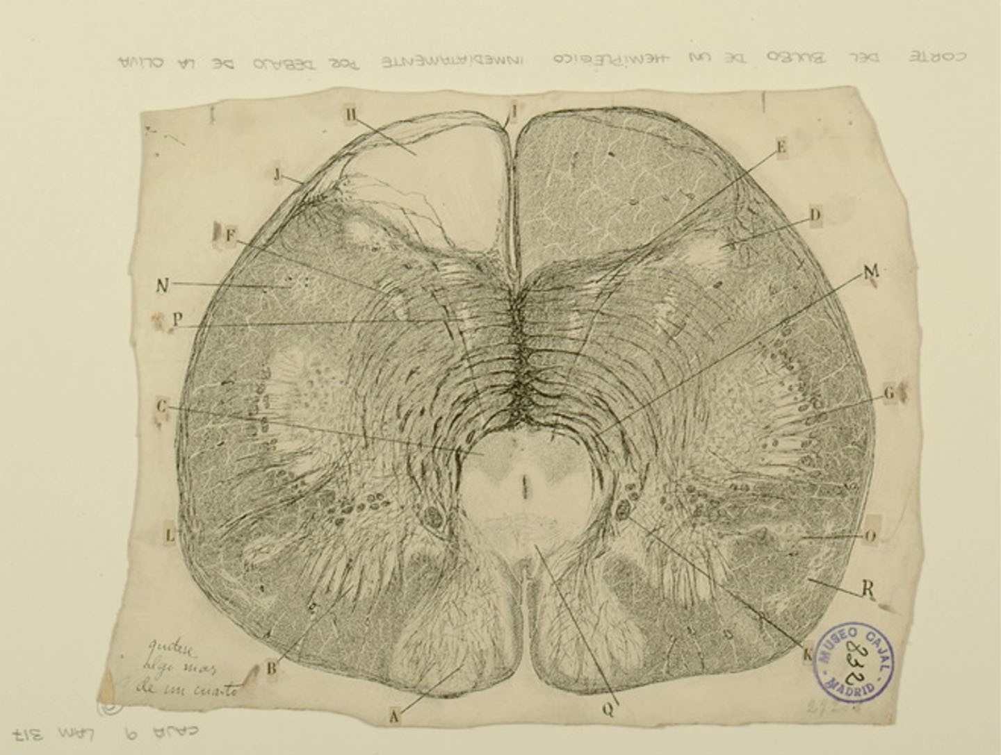 Illustration of a Medulla oblongata from a hemiplegic individual