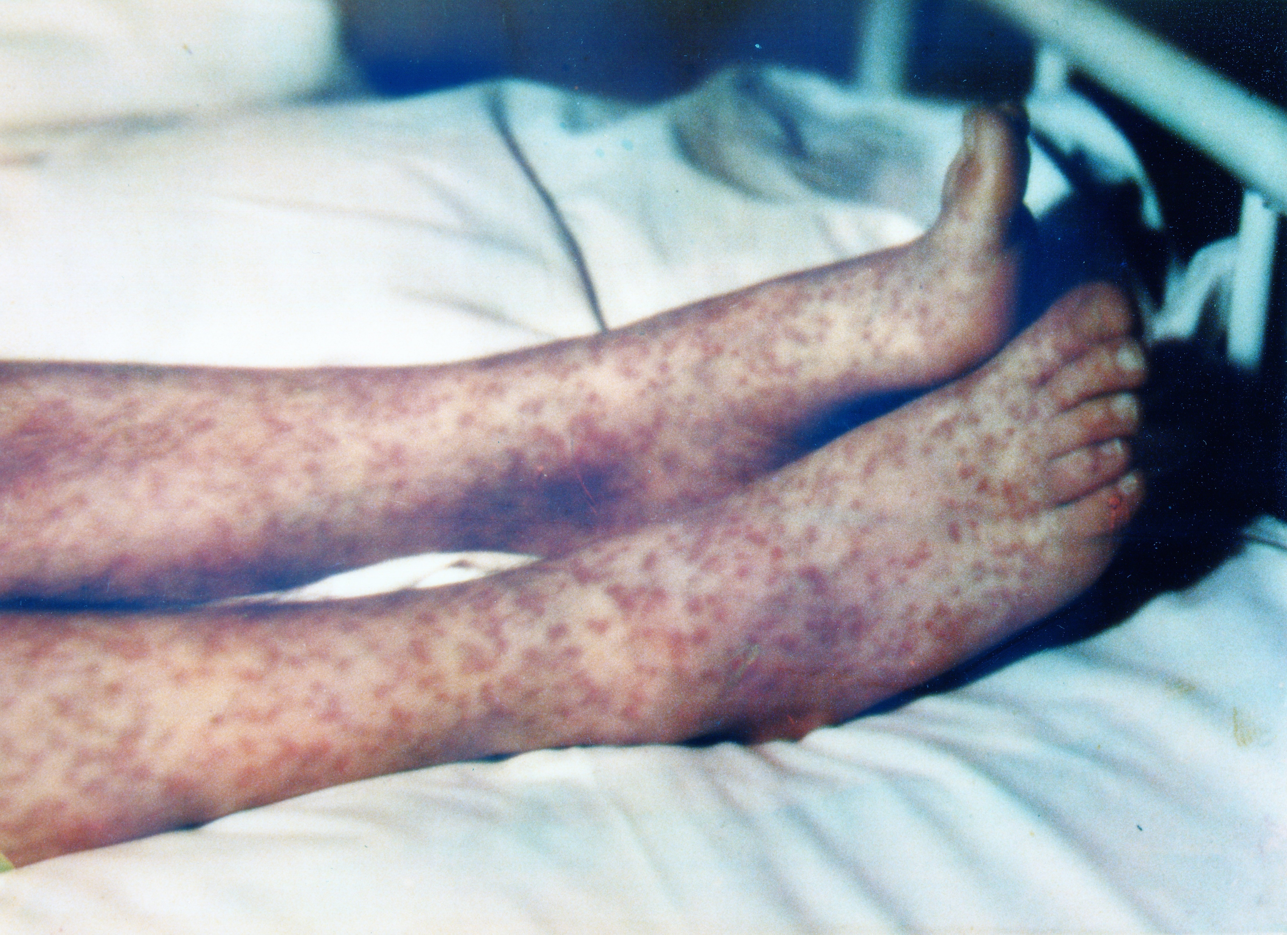 A red rash covers the legs of a person with RMSF