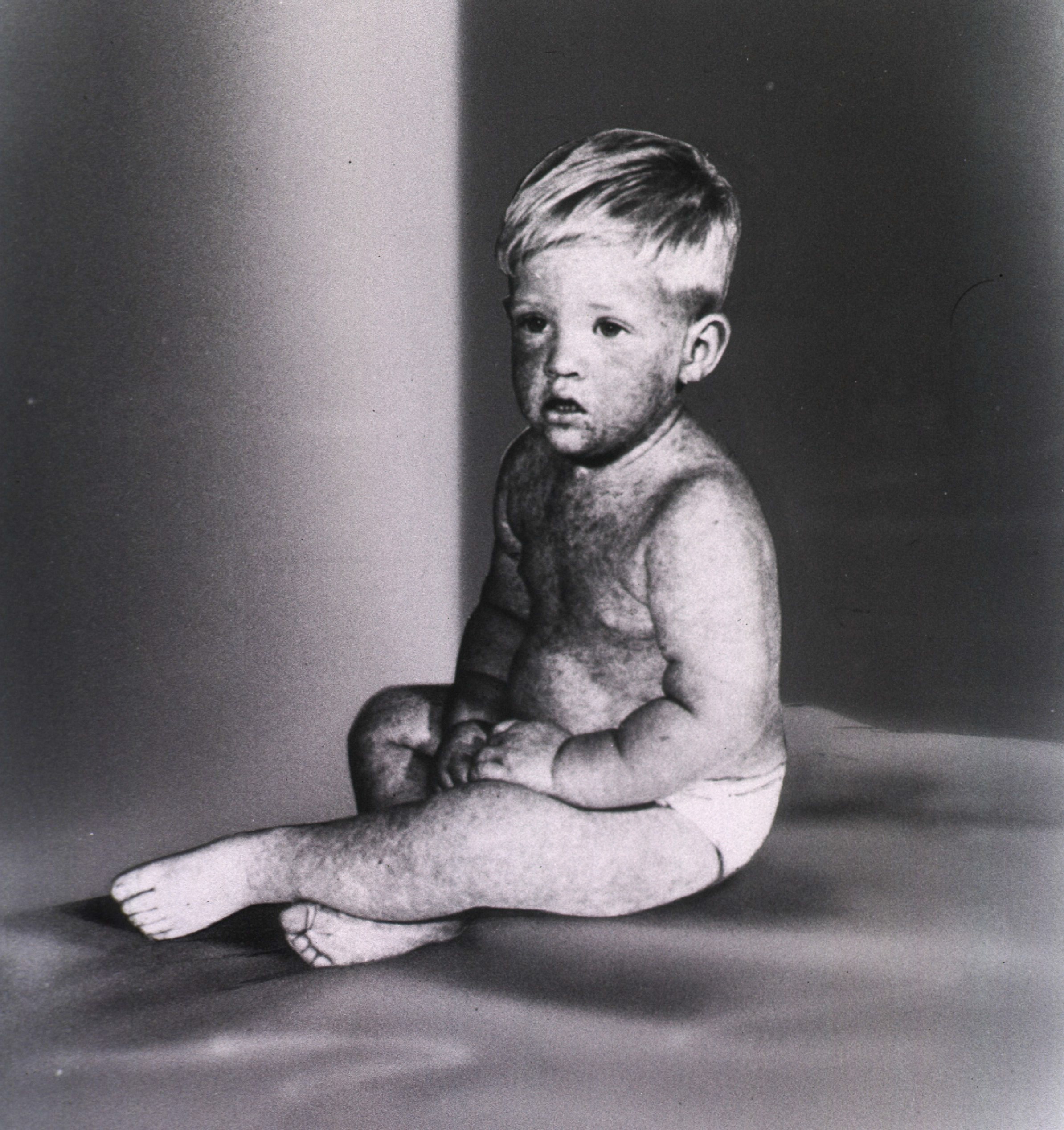 A black and white photograph male toddler seated in a diaper with red spots all over his skin from measles.
