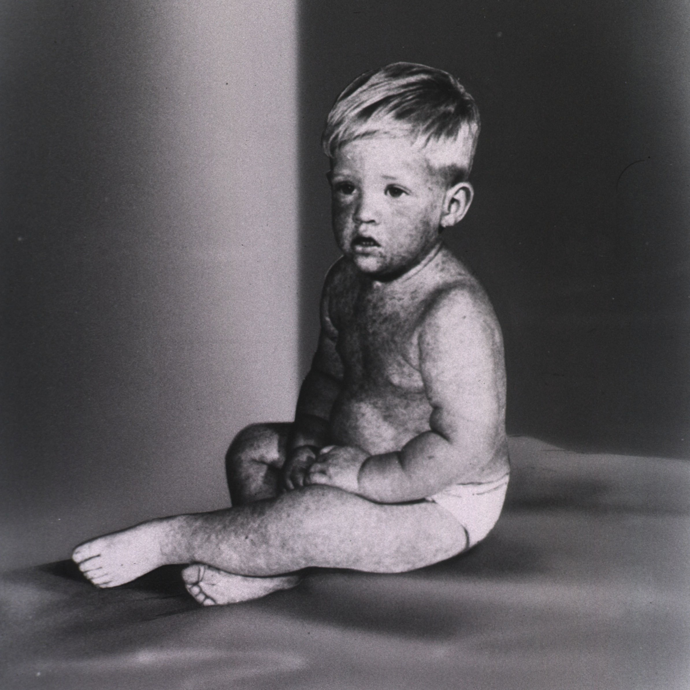 A monochromatic image of a toddler covered in a rash due to a measles infection