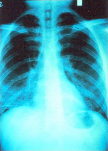 Lung X-ray of patient shows infection with Pneumocystis carinii pneumonia