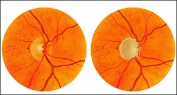 Painting of a normal optic disc and a glaucomatous optic disc