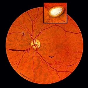 Painting of a retina of a patient with uveitis