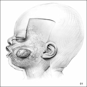 Sequential Dissections of the Head from the Side starting with salivary glands and skin