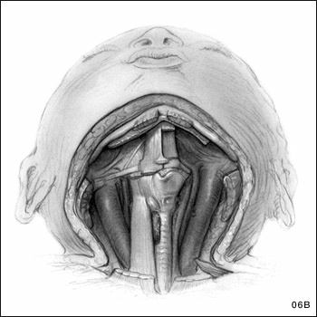 Hand-drawn illustration of Sequential Dissections of the Head from the Side