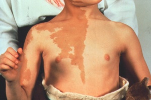 photo of a girl showing skin pigmentation as a result of disease